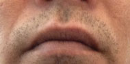 Tbc_5_before